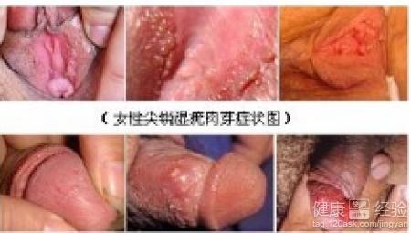 尖锐性湿疣可以吃茭瓜,战胜尖锐性湿疣——天然食疗新选择”